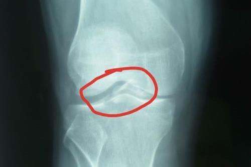 胫骨髁间嵴撕脱性骨折X线图