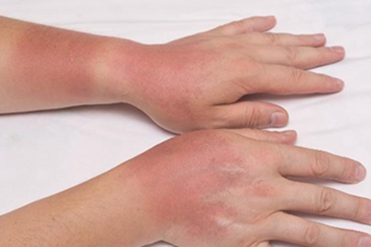 光毒性接触性皮炎手背发红图