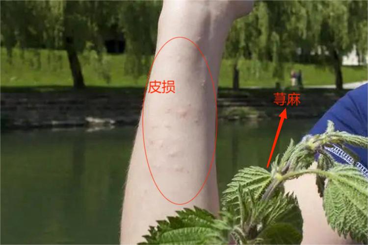 荨麻草蜇人症状图