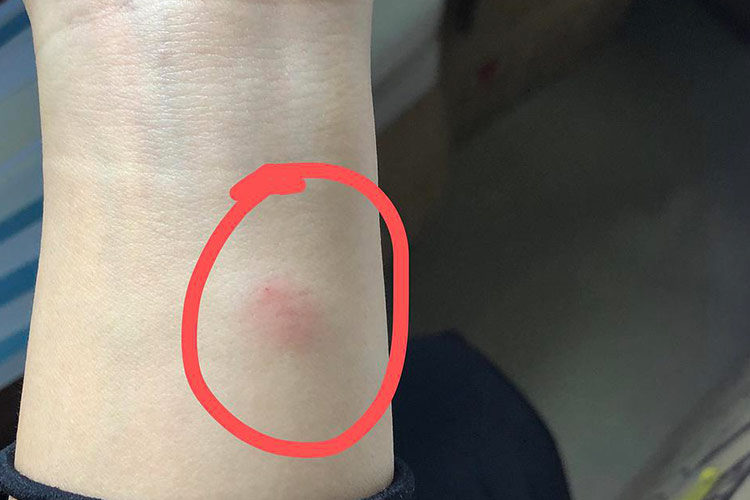 皮试过敏判断图片