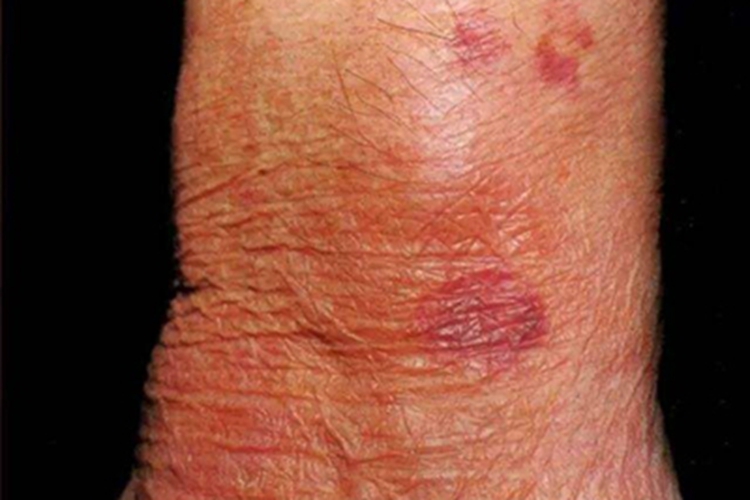 血管萎缩性皮肤异色病脚踝症状图 血管萎缩性皮肤异色病脚踝症状图