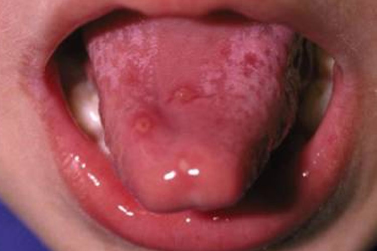 舌缘疱疹图