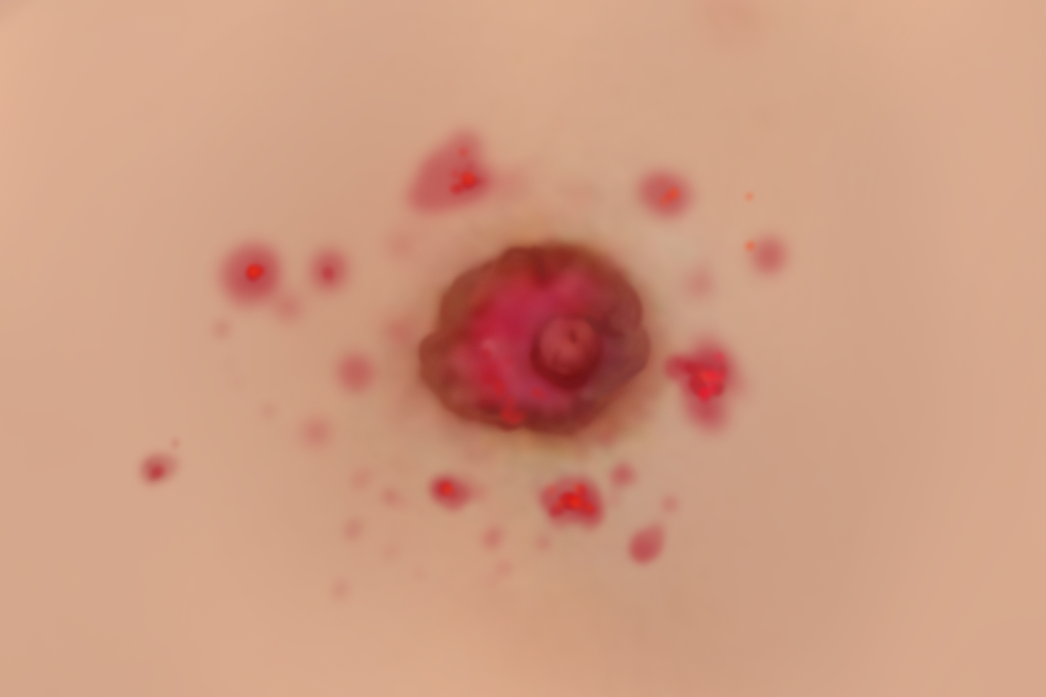 男性湿疹样癌乳头手绘图