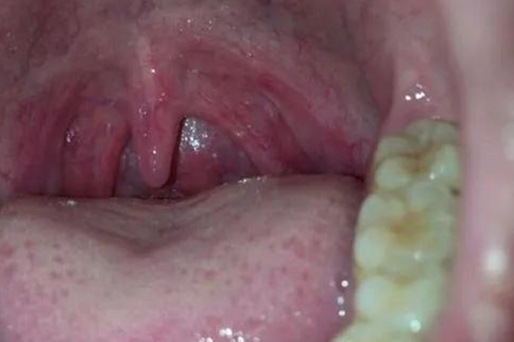 慢性咽炎位置图 慢性咽炎位置图