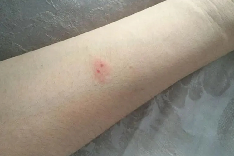 中小型蜈蚣咬伤图