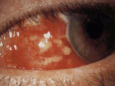 坏死性前巩膜炎眼睛发红有多个疙瘩图.jpg