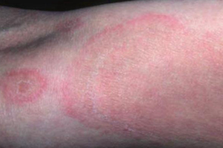 离心性环形红斑胳膊症状图