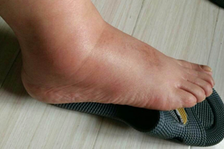 蜂窝织炎脚背肿胀图