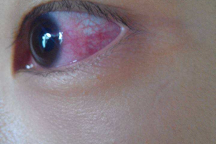斑疹伤寒眼睛血丝图 斑疹伤寒眼睛血丝图