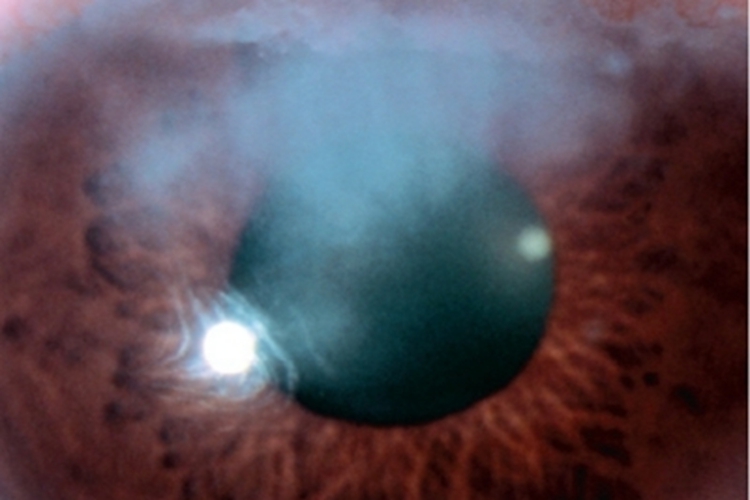 先天性梅毒性角膜基质炎角膜斑图