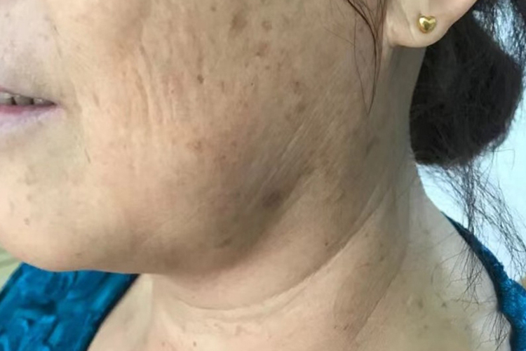 脖子及颌面部老年斑图 脖子及颌面部老年斑图