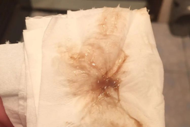 怀孕38周褐色分泌物图