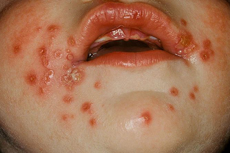 疱疹样湿疹面部小水疱图