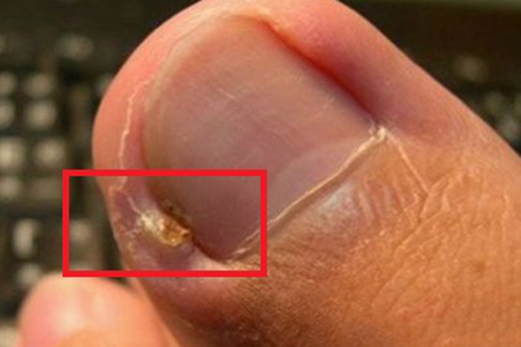 化脓性甲沟炎脚趾小疙瘩图 化脓性甲沟炎脚趾小疙瘩图