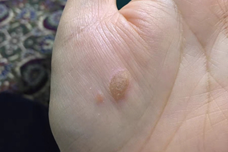 扁平疣手掌症状图