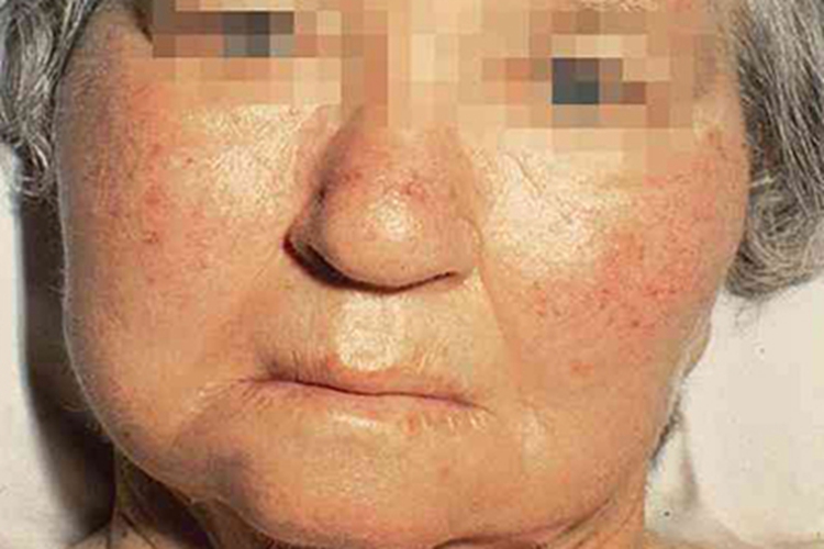 全身性黏液性水肿面部水肿图