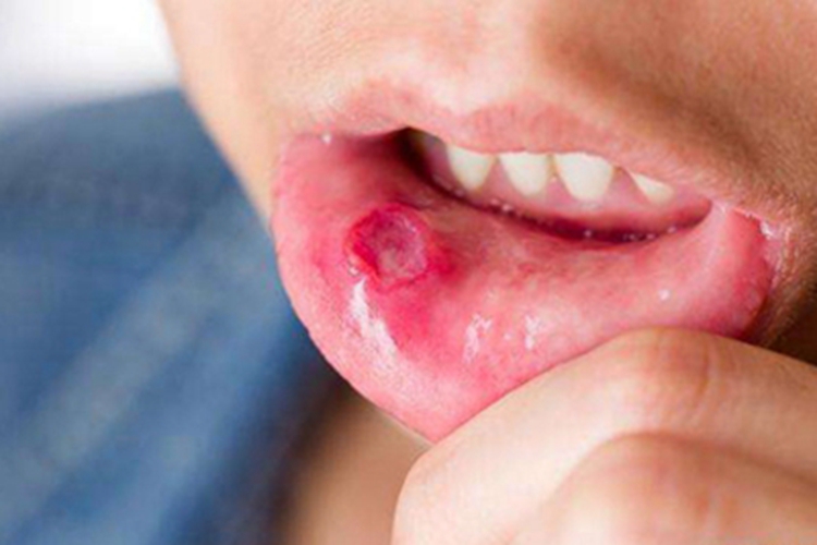 口腔溃疡严重图