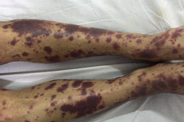 成人ITP下肢紫癜图