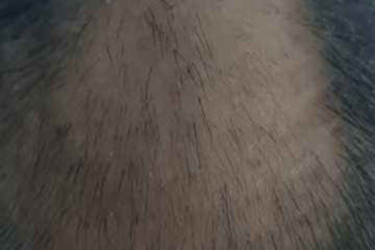 拔毛癖头顶一大片秃了图