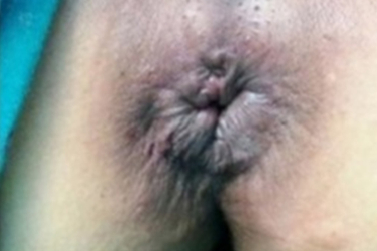 混合痔手术30天后图