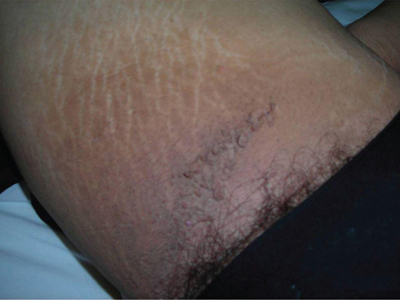 假性黑棘皮病大腿根部有黑色的纹路图.jpg