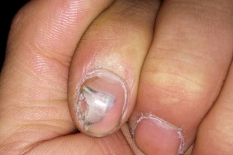 甲分离食指指甲不规则剥离图
