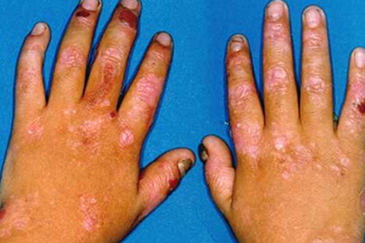 单纯型大疱性表皮松解症图 单纯型大疱性表皮松解症图