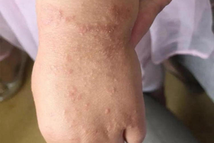 儿童期特应性皮炎手背症状图