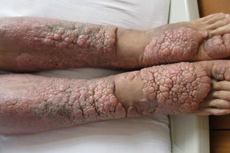 胫前黏液性水肿小腿长肉疙瘩图