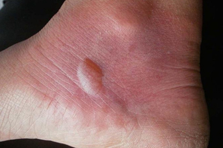 脓毒败血症疹水疱图