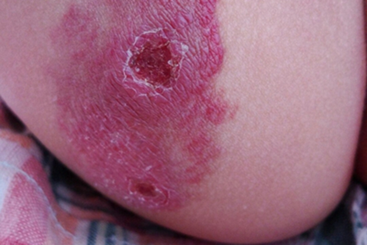 弥漫性躯体性血管角化瘤溃疡图