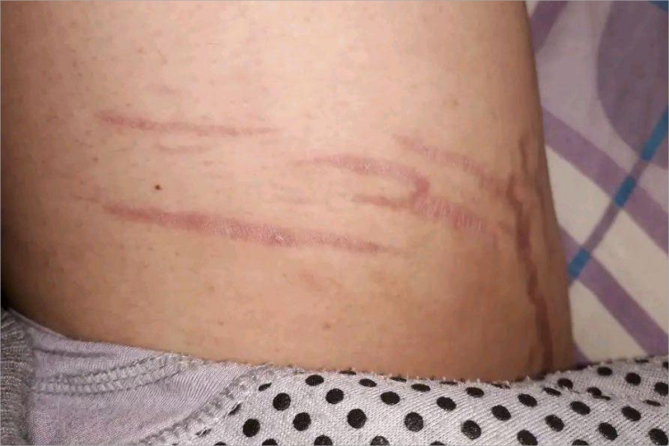 人工皮炎大腿疤痕图 人工皮炎大腿疤痕图