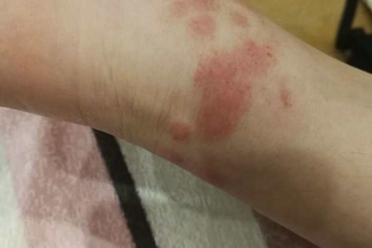 跳蚤叮咬脚踝长红斑图
