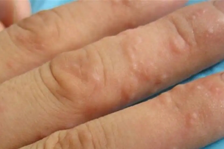 水疱型手癣图