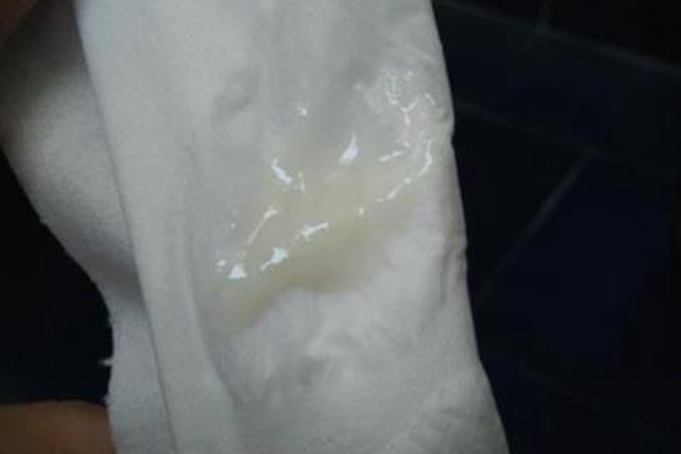 细菌性阴道病白带增多图