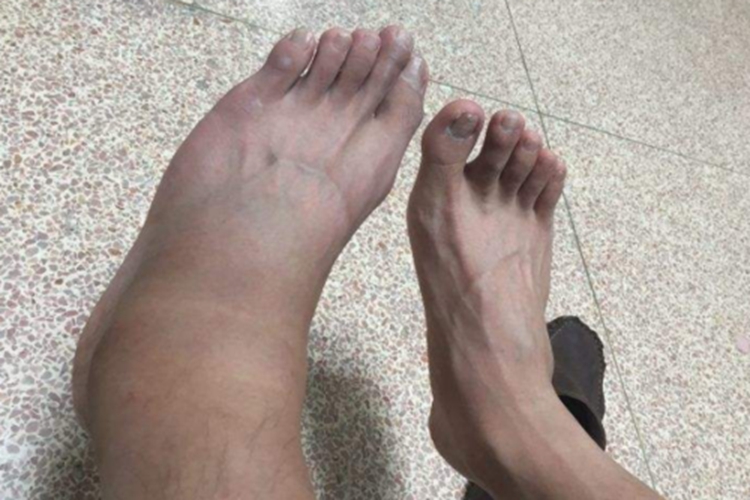 崴脚了伤到韧带肿胀图