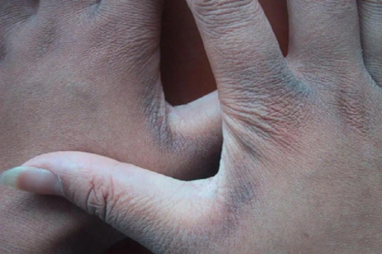 黑棘皮病手部皮肤颜色加深图 黑棘皮病手部皮肤颜色加深图