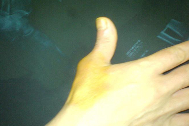 大拇指半脱位症状图