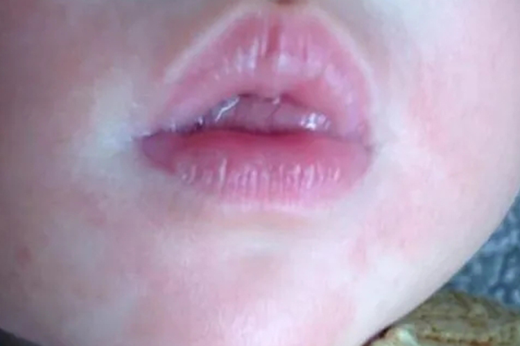 婴儿米粉过敏面部红斑图