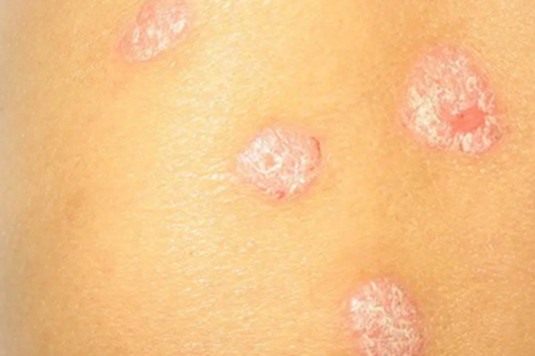 银屑病消退期圆形白斑图