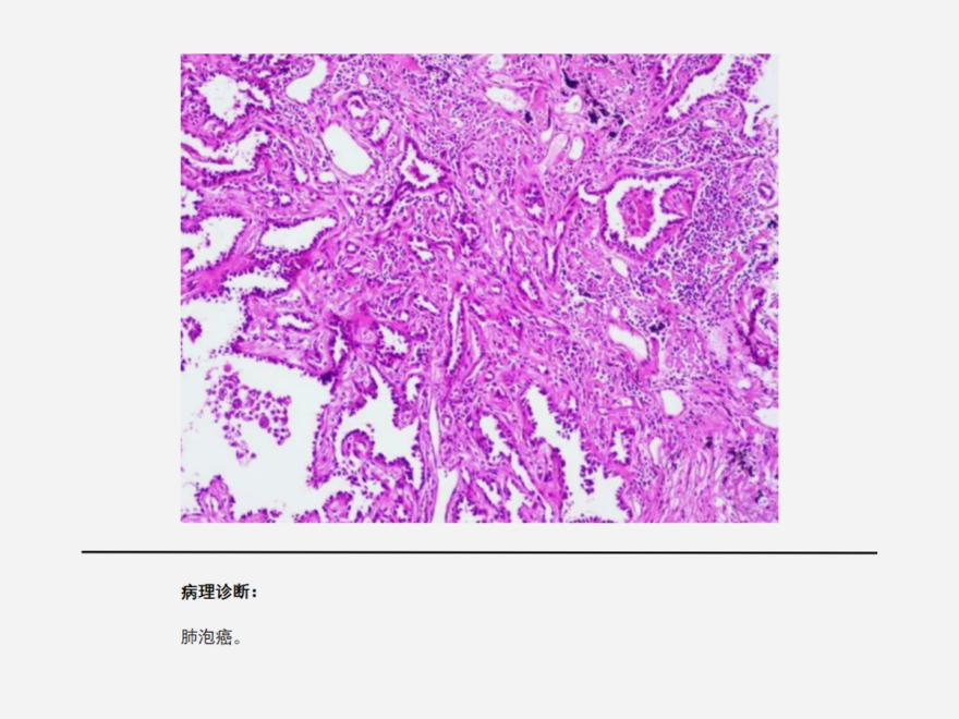 肺泡癌（早期肺泡癌咳痰带血，手术联合放疗及时干预！）.jpg