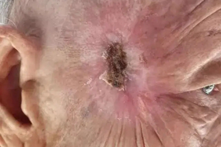 头部鳞状细胞癌面部焦痂图