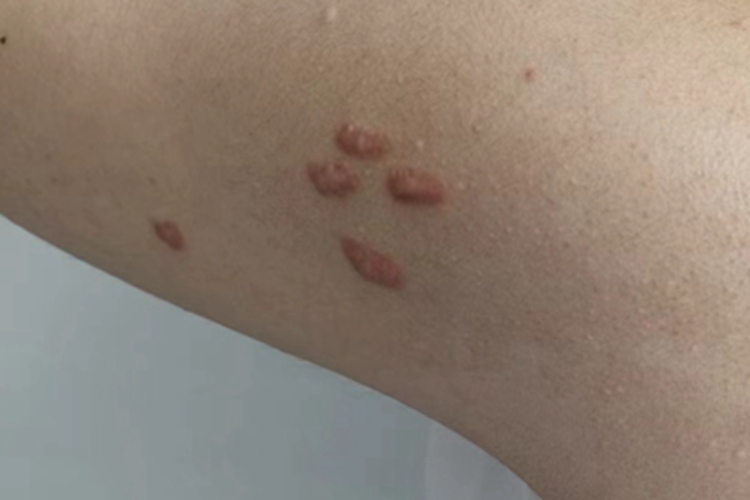 瘢痕疙瘩胳膊有疙瘩样突起图