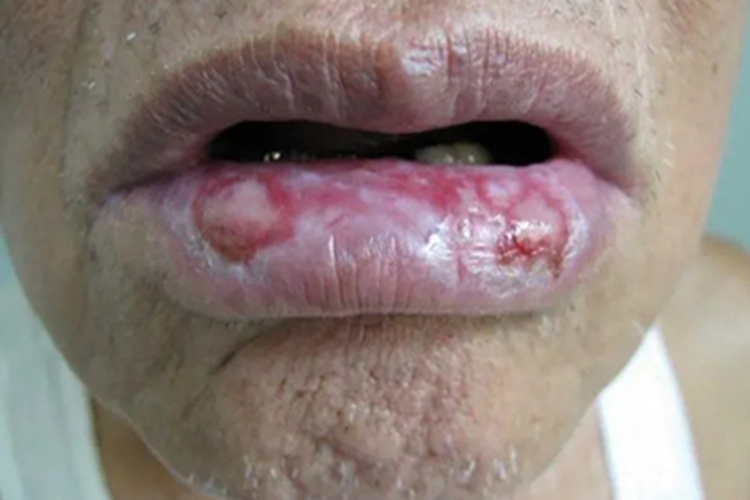 二期口腔梅毒嘴唇烂了发白图