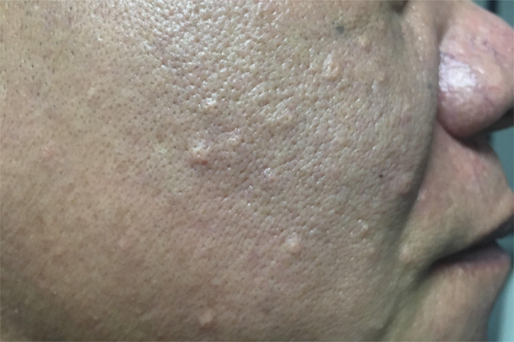 皮脂腺增生小疙瘩图