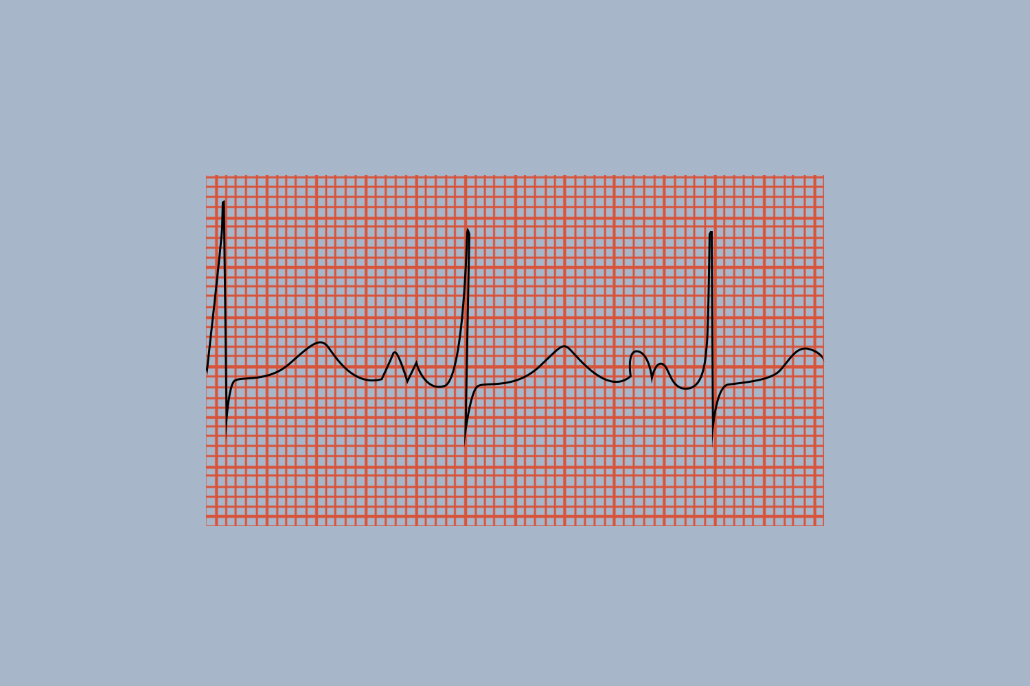 P波增大合并切迹图