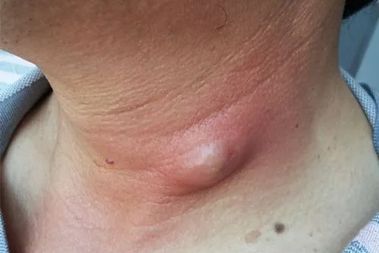 皮脂腺囊肿颈部长疙瘩图