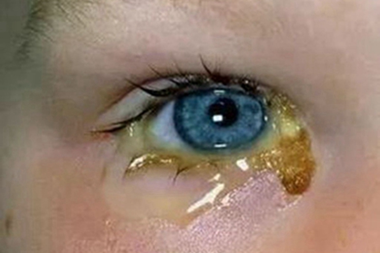 细菌性结膜炎眼周症状图<br />
##@@需裁剪