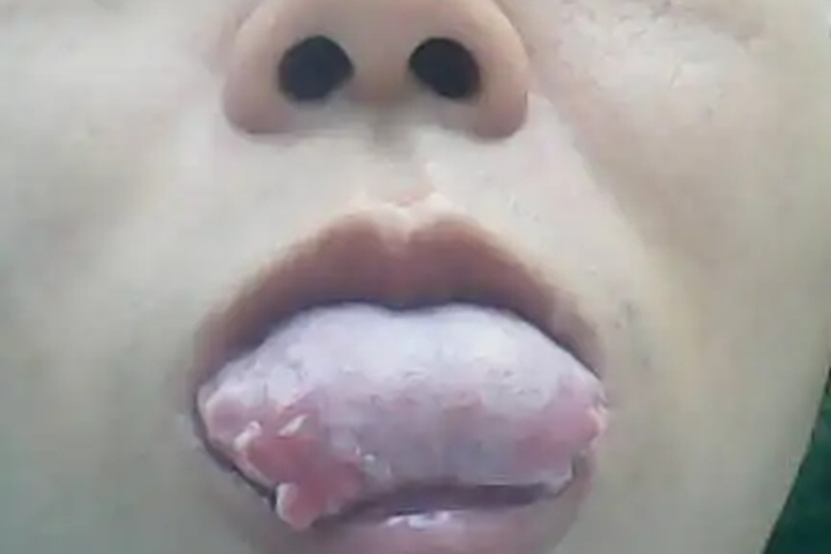 舌癌舌苔长红色肉粒图