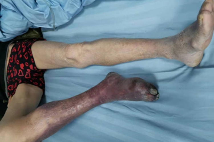 血栓闭塞性脉管炎小腿青紫图 血栓闭塞性脉管炎小腿青紫图